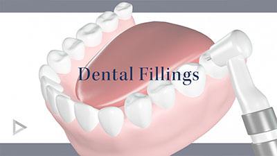fillings